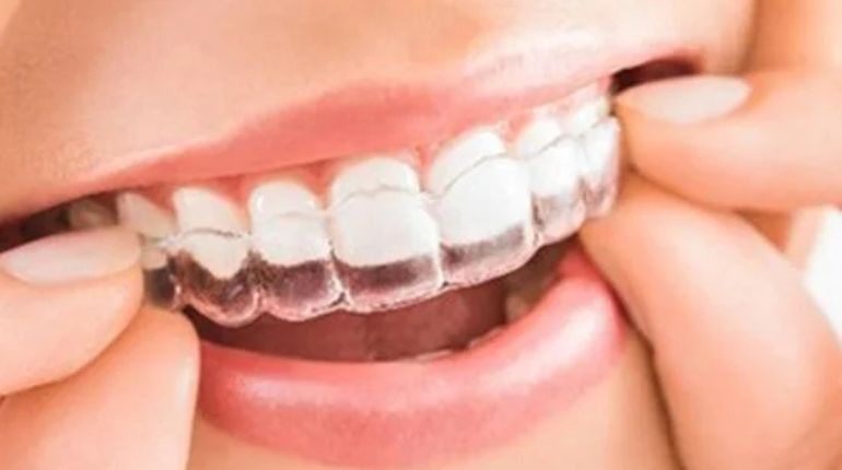 Self ligating Braces